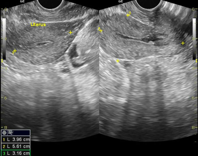File:Anterior abdominal wall abscess - post LSCS (Radiopaedia 30343-30989 E 1).jpg