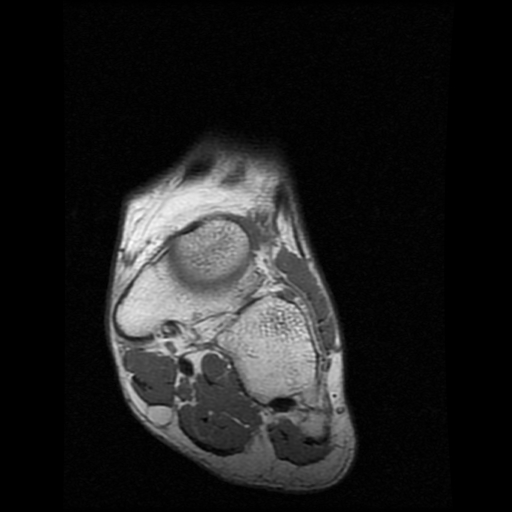 File:Anterior calcaneal process fracture (Radiopaedia 74654-85611 Coronal T1 2).jpg
