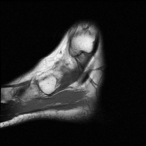 File:Anterior calcaneal process fracture (Radiopaedia 74654-85611 Sagittal T1 3).jpg