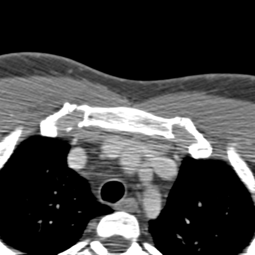 File:Anterior cerebral artery territory infarct (Radiopaedia 39327-41581 B 108).png