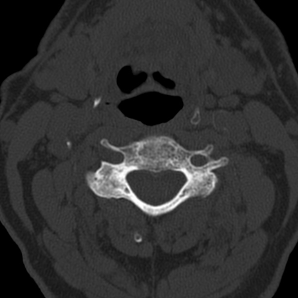 Anterior cervical postdiscectomy arthrodesis (Radiopaedia 32678-33646 Axial bone window 34).jpg