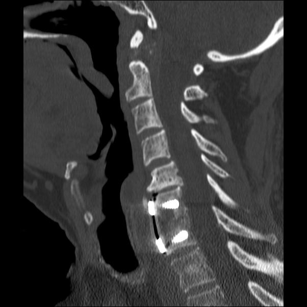 Anterior cervical postdiscectomy arthrodesis (Radiopaedia 32678-33646 Sagittal bone window 42).jpg
