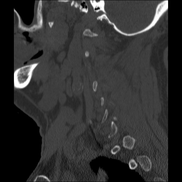 Anterior cervical postdiscectomy arthrodesis (Radiopaedia 32678-33646 Sagittal bone window 64).jpg