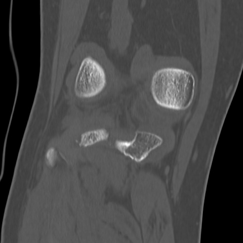 File:Anterior cruciate ligament avulsion fracture (Radiopaedia 58939-66194 Coronal bone window 27).jpg