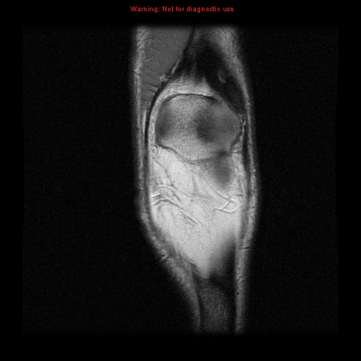 File:Anterior cruciate ligament injury - partial thickness tear (Radiopaedia 12176-12515 Coronal PD 2).jpg