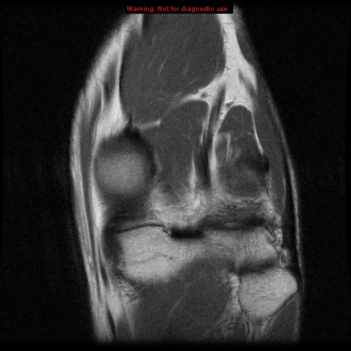 File:Anterior cruciate ligament injury - partial thickness tear (Radiopaedia 12176-12515 D 10).jpg
