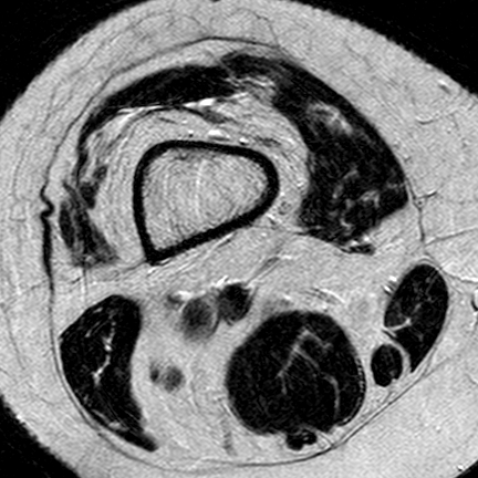 File:Anterior cruciate ligament mucoid degeneration (Radiopaedia 60853-68633 Axial T2 31).jpg