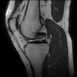 File:Anterior cruciate ligament rupture and posteromedial corner injury (Radiopaedia 67338-76723 Sagittal PD 71).jpg