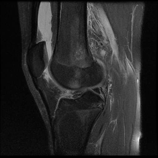 File:Anterior cruciate ligament tear (Radiopaedia 61500-69462 Sagittal PD fat sat 12).jpg