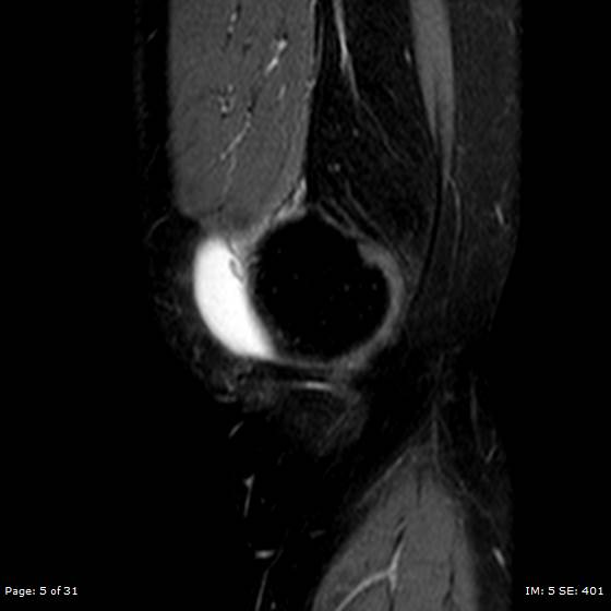 File:Anterior cruciate ligament tear (Radiopaedia 70783-80964 Sagittal STIR 5).jpg