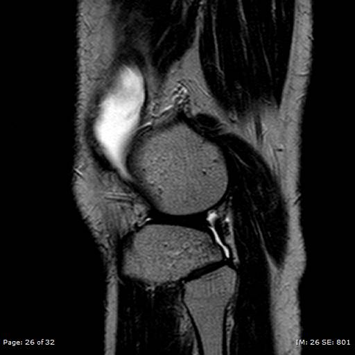 File:Anterior cruciate ligament tear (Radiopaedia 70783-80964 Sagittal T2 26).jpg