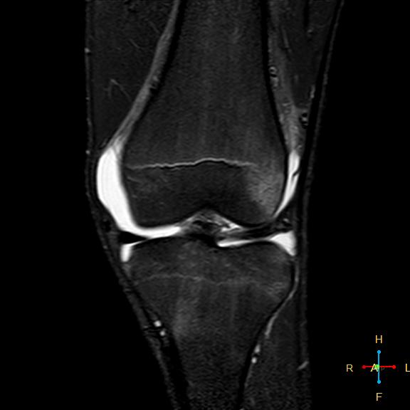 File:Anterior cruciate ligament tear - complete (Radiopaedia 24907-25170 Coronal STIR 8).jpg