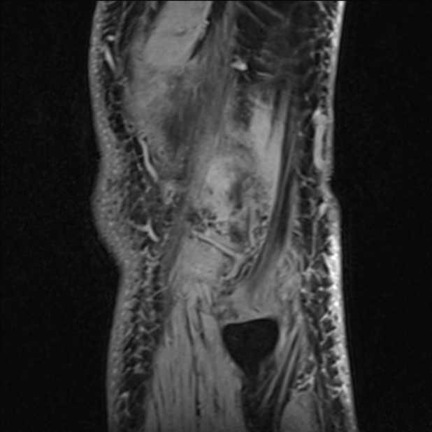 Anterior cruciate ligament tear - ramp lesion (Radiopaedia 71883-82322 Sagittal T1 vibe 16).jpg