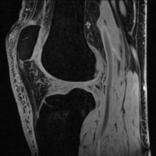 Anterior cruciate ligament tear - ramp lesion (Radiopaedia 71883-82322 Sagittal T1 vibe 60).jpg