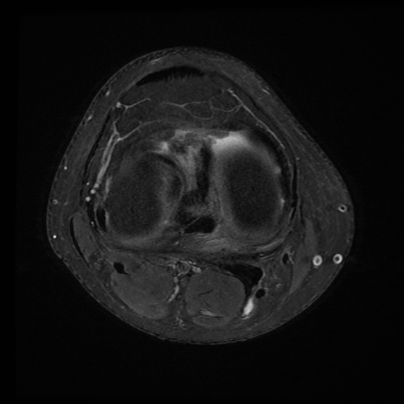 File:Anterior cruciate ligament tear with posteromedial corner injury, bucket-handle meniscal tear and chondral delamination (Radiopaedia 75501-86744 Axial PD fat sat 10).jpg