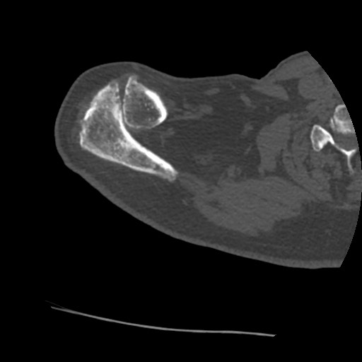 Anterior glenohumeral dislocation with Hill-Sachs lesion (Radiopaedia 62877-71249 Axial bone window 11).jpg