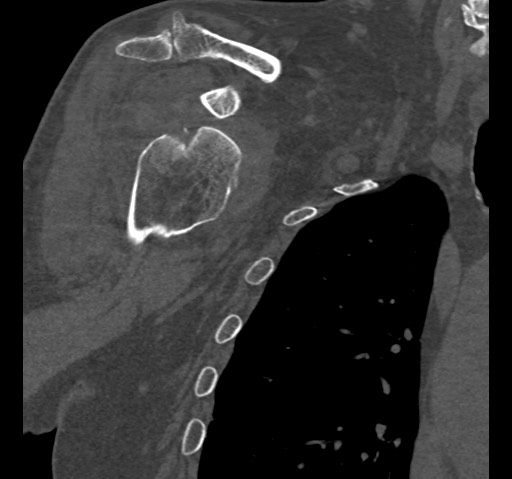 Anterior glenohumeral dislocation with Hill-Sachs lesion (Radiopaedia 62877-71249 Coronal bone window 31).jpg