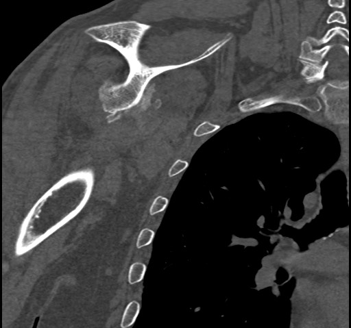 Anterior glenohumeral dislocation with Hill-Sachs lesion (Radiopaedia 62877-71249 Coronal bone window 65).jpg
