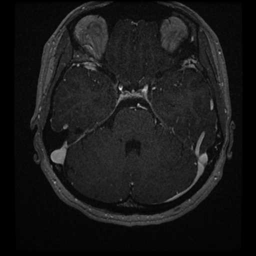 Anterior inferior cerebellar artery vascular loop - type II (Radiopaedia 70991-81209 Axial T1 C+ 18).jpg