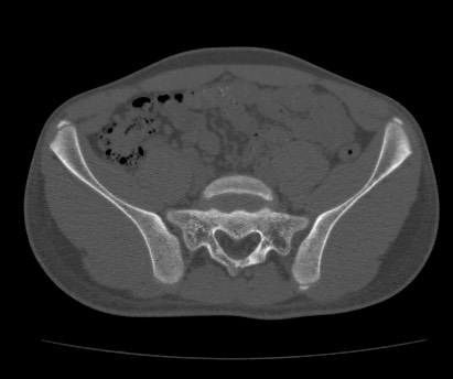 File:Anterior inferior iliac spine avulsion fracture (Radiopaedia 81312-94999 Axial bone window 25).jpg