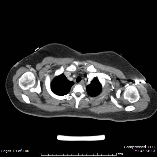 Anterior mediastinal B cell Lymphoma (Radiopaedia 50677-56114 A 10).jpg
