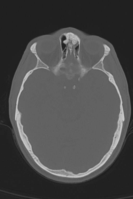 Anterior nasal spine fracture (Radiopaedia 46138-50494 Axial bone window 36).png
