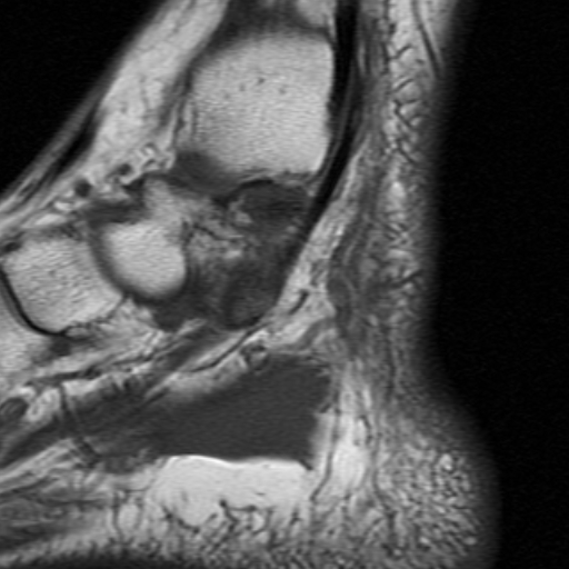 File:Anterior talofibular ligament rupture (Radiopaedia 15831-15484 Sagittal T1 16).jpg