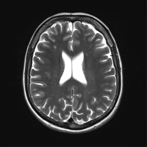 File:Anterior temporal lobe perivascular space (Radiopaedia 40946-43650 Axial T2 24).png