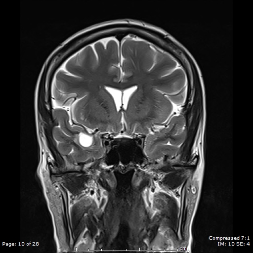 File:Anterior temporal lobe perivascular space (Radiopaedia 88283-104914 Coronal T2 10).jpg
