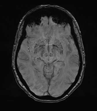 Anterior temporal pole cysts (Radiopaedia 46629-51102 Axial SWI 40).png