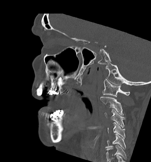 File:Anterior temporomandibular joint dislocation (Radiopaedia 59430-66784 B 40).jpg