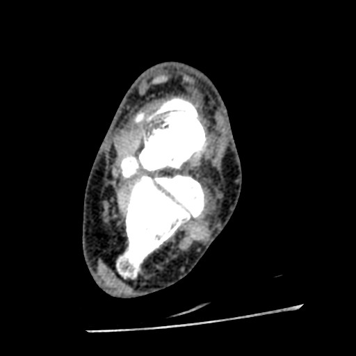 File:Anterior tibial artery false aneurysm (Radiopaedia 88984-105809 A 154).jpg