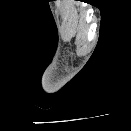 Anterior tibial artery false aneurysm (Radiopaedia 88984-105809 A 253).jpg