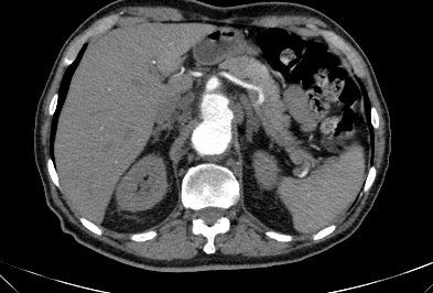 File:Anterior vertebral scalloping (abdominal aortic aneurysm) (Radiopaedia 66744-76067 F 10).jpg