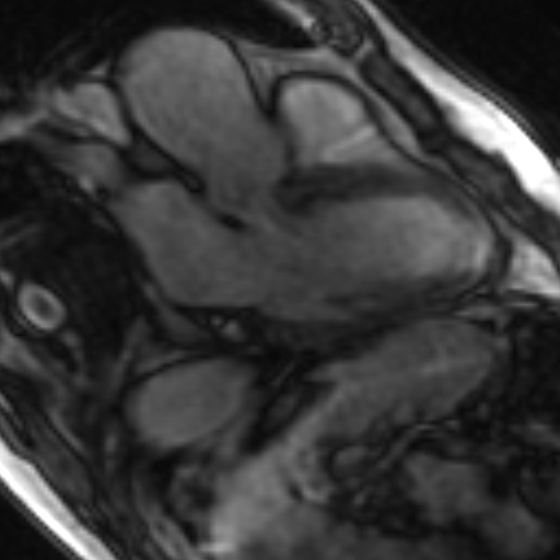 File:Anteroseptal hypokinesia after myocardial infarction (Radiopaedia 15978-15633 3 chamber view SSFE 14).jpg