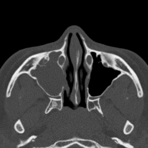Antrochoanal polyp (Radiopaedia 33984-35202 Axial bone window 30).jpg
