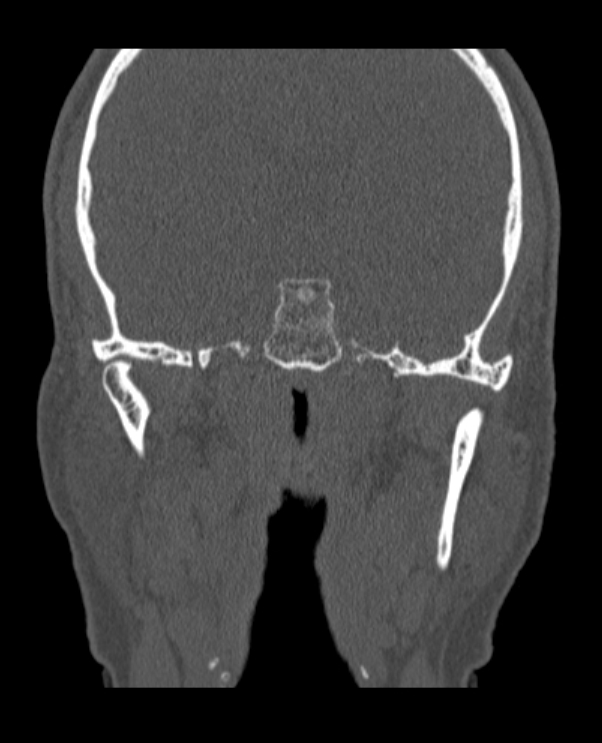 Antrochoanal polyp (Radiopaedia 79011-92169 Coronal bone window 2).jpg