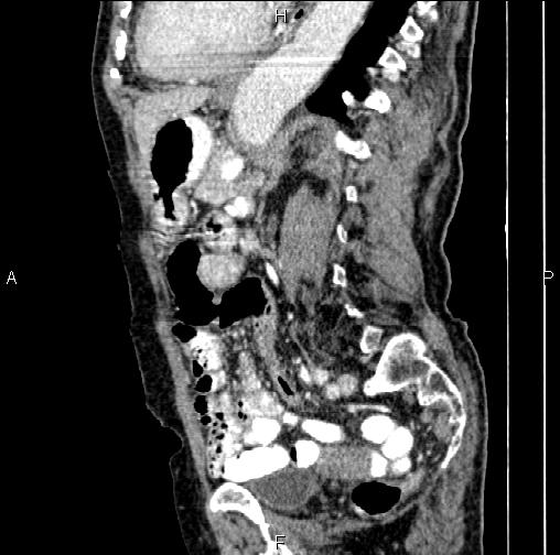 File:Aortic aneurysm and Lemmel syndrome (Radiopaedia 86499-102554 D 55).jpg