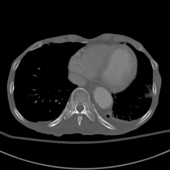 Aortic aneurysm with spinal destruction (Radiopaedia 42301-45410 Axial bone window 2).jpg