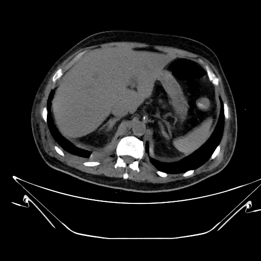 Aortic arch aneurysm (Radiopaedia 84109-99365 Axial non-contrast 272).jpg