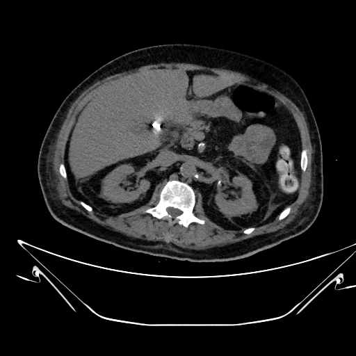 Aortic arch aneurysm (Radiopaedia 84109-99365 Axial non-contrast 312).jpg