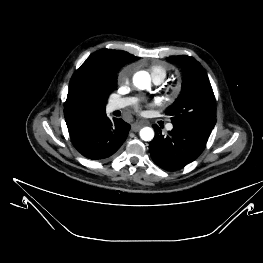 Aortic arch aneurysm (Radiopaedia 84109-99365 C 218).jpg