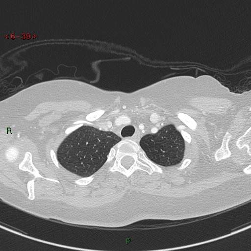 File:Aortic arch origin of left vertebral artery (Radiopaedia 51520-57286 Axial lung window 39).jpg