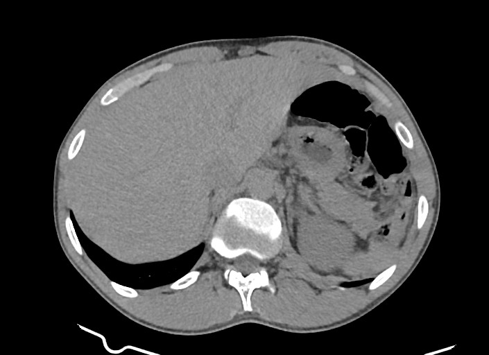 File:Aortic coarctation with aneurysm (Radiopaedia 74818-85828 A 31).jpg