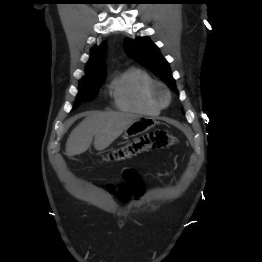 File:Aortic dissection- Stanford A (Radiopaedia 37759-39664 Coronal C+ delayed 4).png