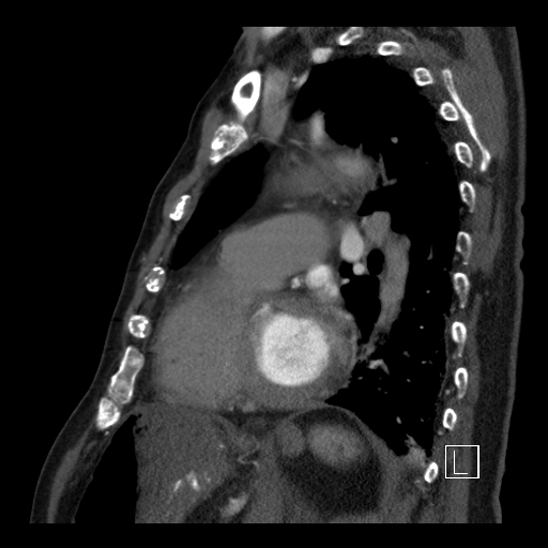 File:Aortic dissection (CTPA) (Radiopaedia 75506-86750 C 69).jpg