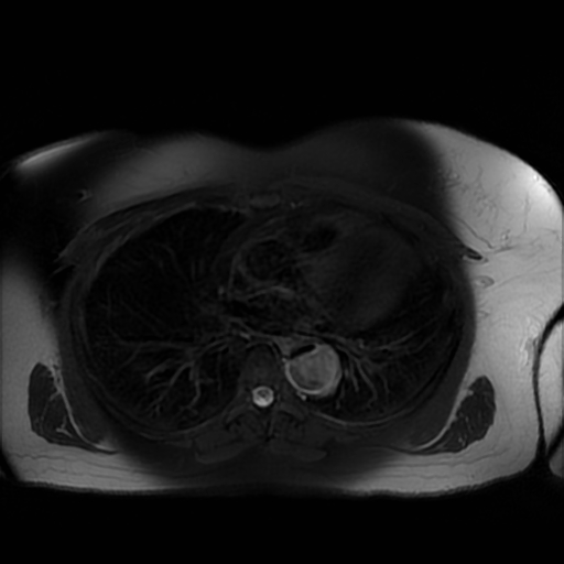 File:Aortic dissection (Radiopaedia 57969-64956 Axial T2 fat sat 4).jpg