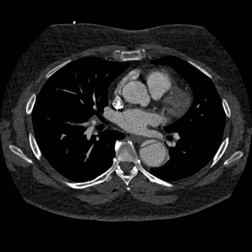 File:Aortic dissection (Radiopaedia 57969-64959 A 163).jpg