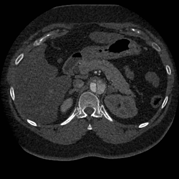 Aortic dissection (Radiopaedia 57969-64959 A 341).jpg