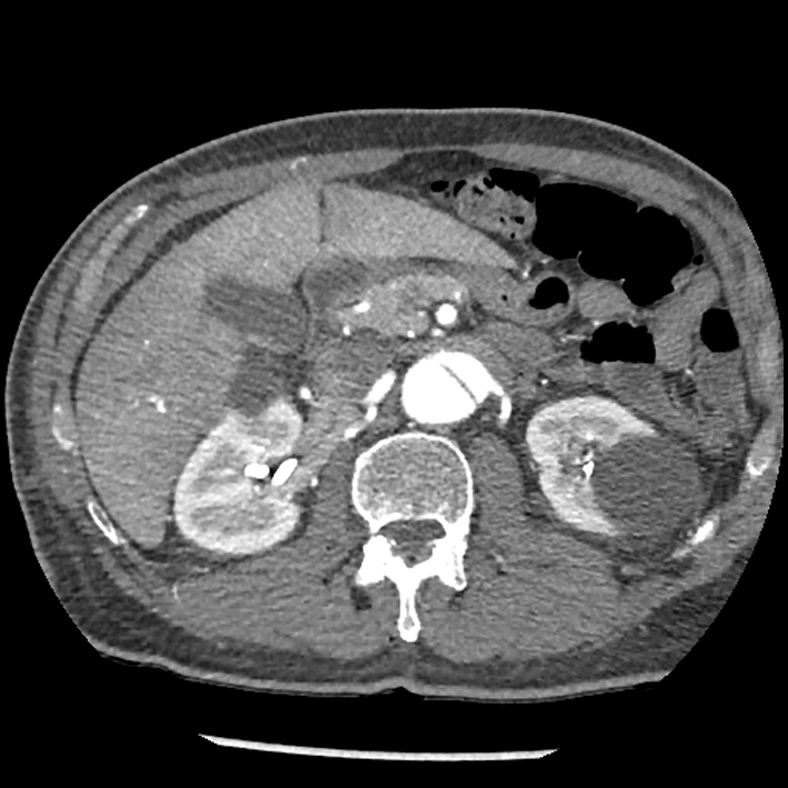 Aortic dissection - DeBakey Type I-Stanford A (Radiopaedia 79863-93115 A 47).jpg